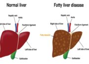 Tujuh Tanda pada Kulit Ini Menunjukkan Kesehatan Liver Anda Terganggu